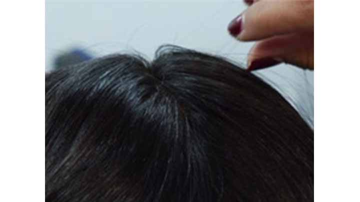 La tricotiloman&iacute;a se produce de manera involuntaria y se calcula que cerca del 4% de la poblaci&oacute;n mundial padece el trastorno.