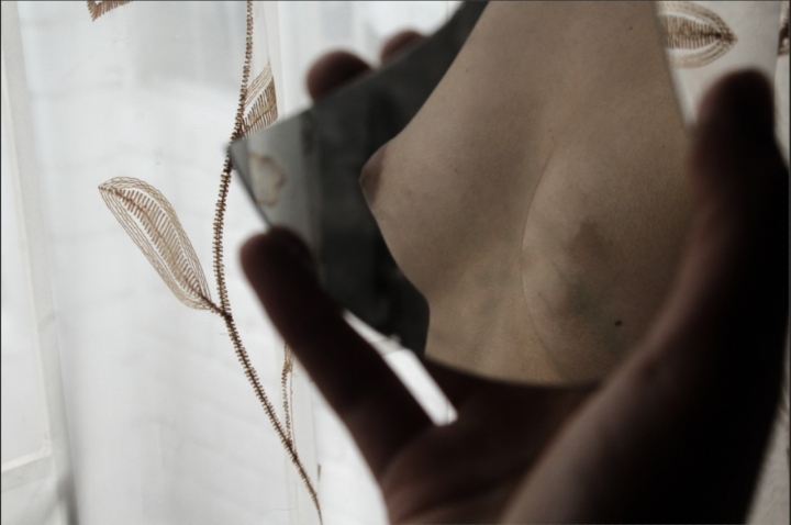 Foto referencia de una mastectom&iacute;a