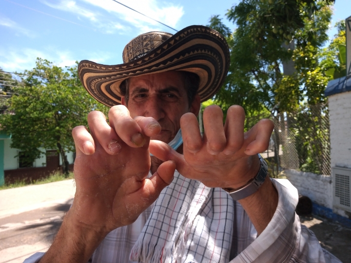 Manuel Llano lleg&oacute; a Agua de Dios hace seis meses con la ilusi&oacute;n de encontrar especialistas para tratar sus heridas, pero seg&uacute;n &eacute;l, hasta ahora no lo ha atendido ning&uacute;n doctor.